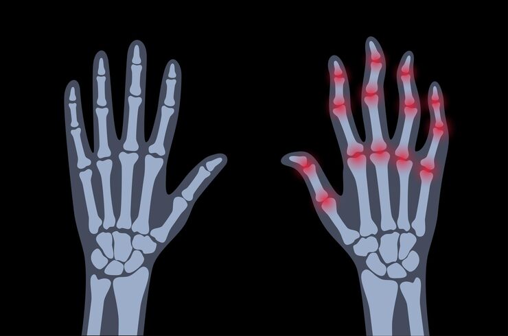 Rheumatoid arthritis